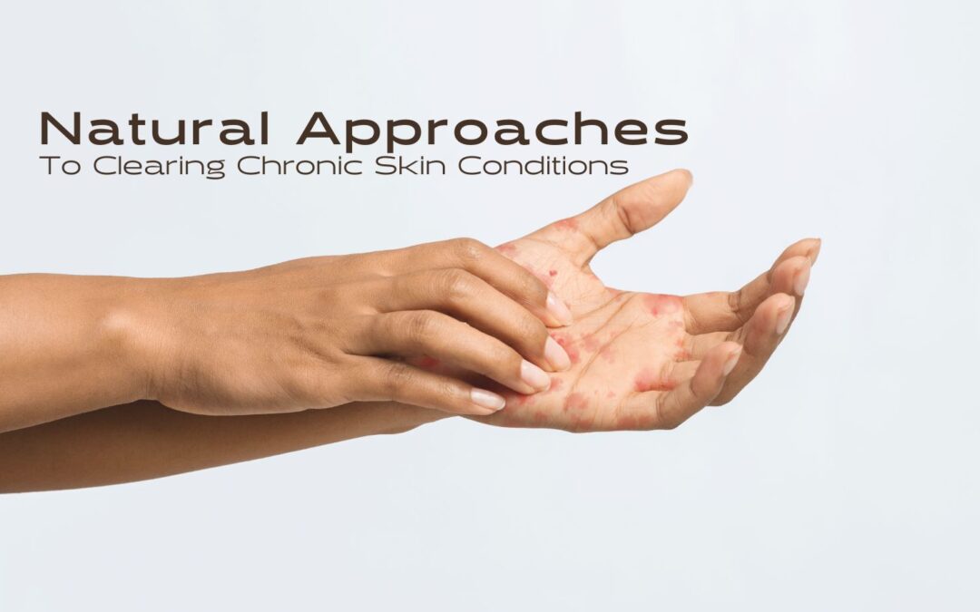 Natural Approaches to Clearing Chronic Skin Conditions
