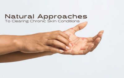 Natural Approaches to Clearing Chronic Skin Conditions